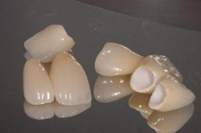 utilizzo nuove ceramiche dentista cassino