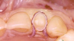 utilizzo nuove ceramiche dentista cassino2