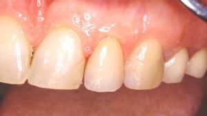 utilizzo nuove ceramiche dentista cassino frosinone rongione