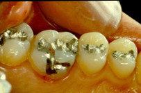amalgama e otturazioni dentista rongione a cassino
